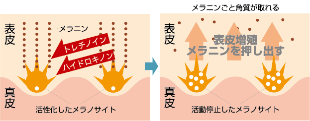 トレチノインの働き